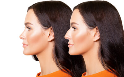 Rhinoplasty: Your Key to a Better-Looking Nose