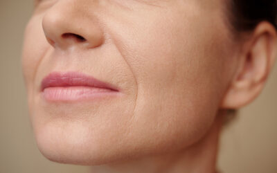Fill Your Marionette Lines with the Help of Juvederm