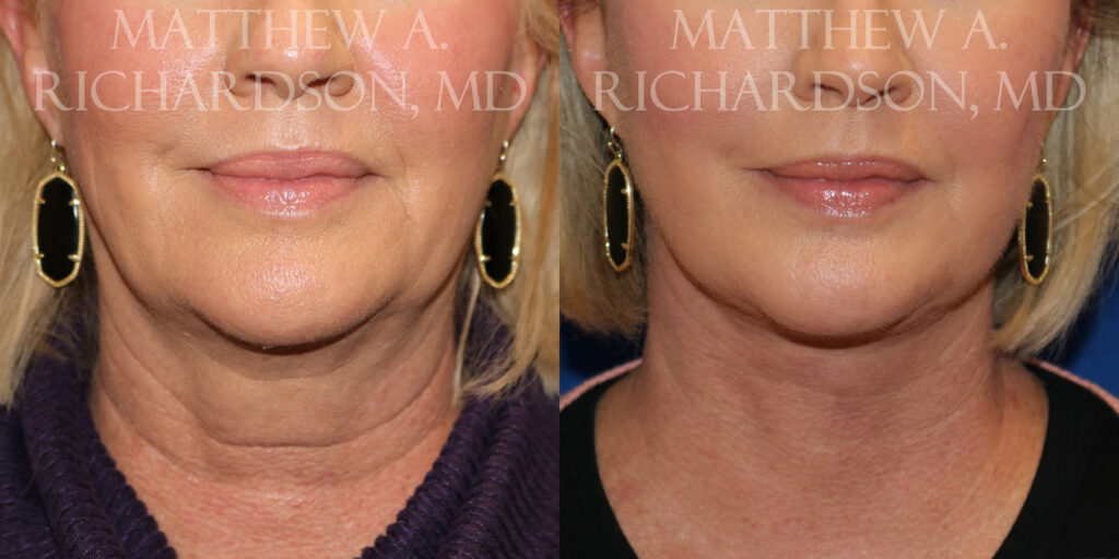 Facelift Before and After photo by Texas Facial Aesthetics in Frisco, TX