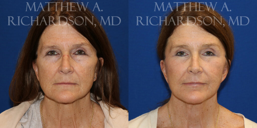 Facelift Before and After photo by Texas Facial Aesthetics in Frisco, TX