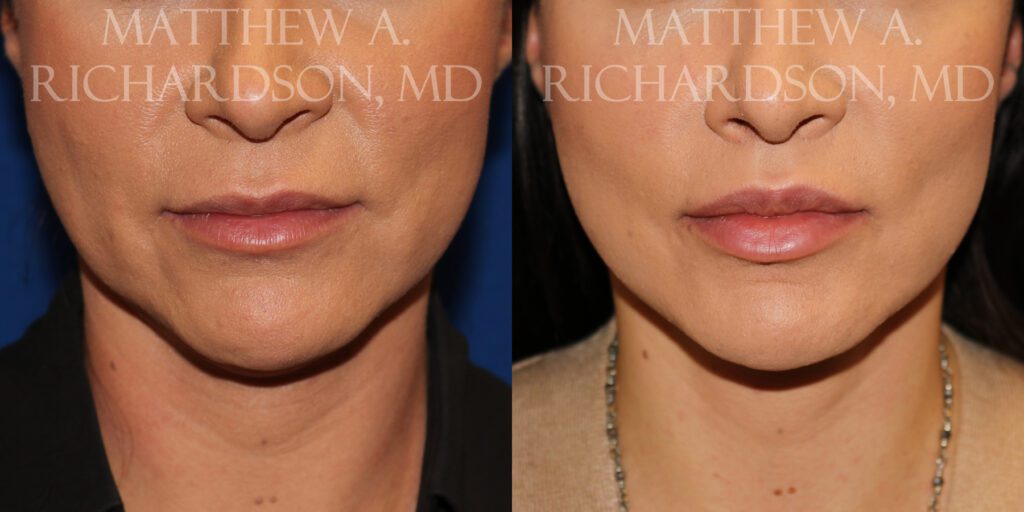 Facelift Before and After photo by Texas Facial Aesthetics in Frisco, TX