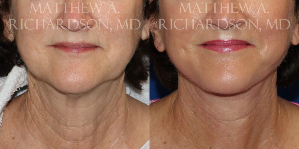 Facelift Before and After photo by Texas Facial Aesthetics in Frisco, TX
