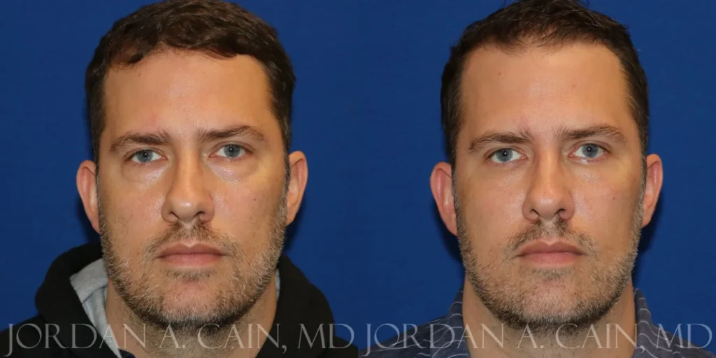 Fat Transfer Before and After photo by Texas Facial Aesthetics in Frisco, TX