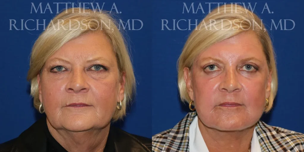 Fat Transfer Before and After photo by Texas Facial Aesthetics in Frisco, TX