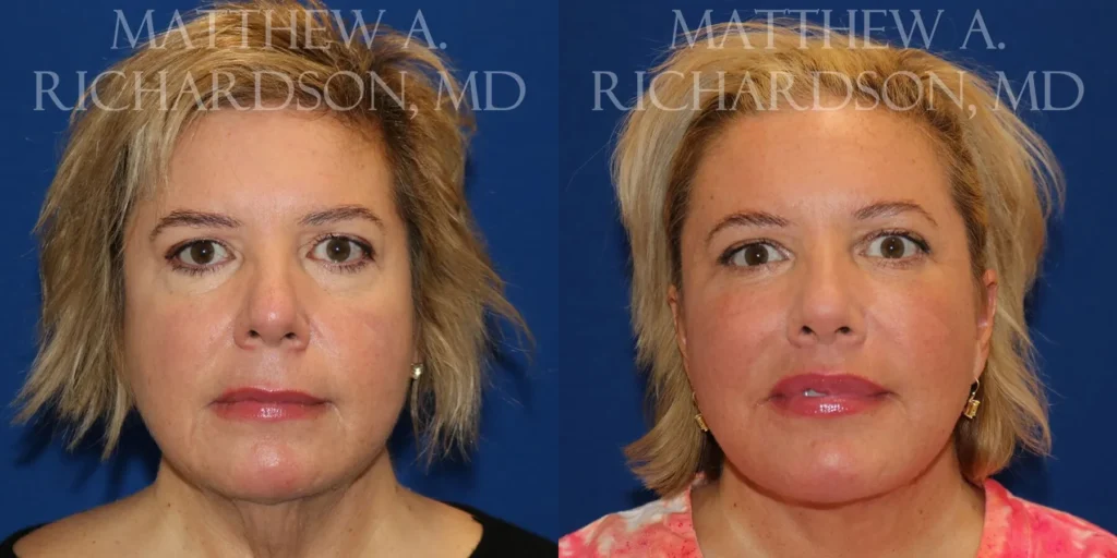 Fat Transfer Before and After photo by Texas Facial Aesthetics in Frisco, TX