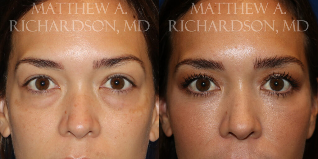 Fat Transfer Before and After photo by Texas Facial Aesthetics in Frisco, TX