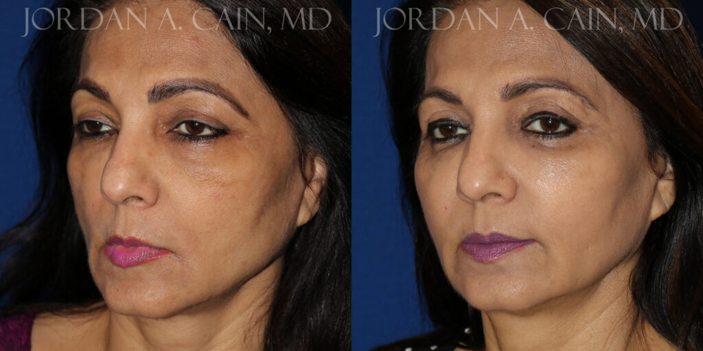 Fat Transfer Before and After photo by Texas Facial Aesthetics in Frisco, TX