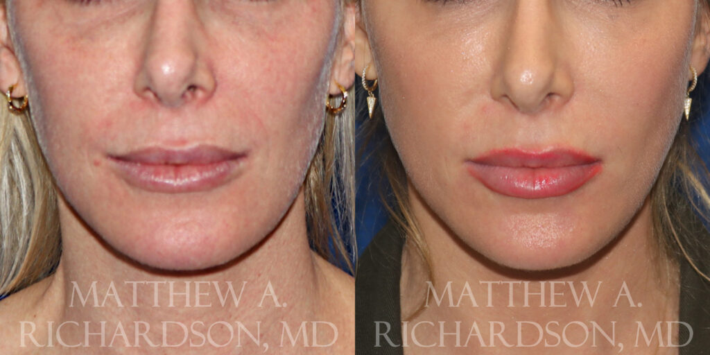 Fat Transfer Before and After photo by Texas Facial Aesthetics in Frisco, TX