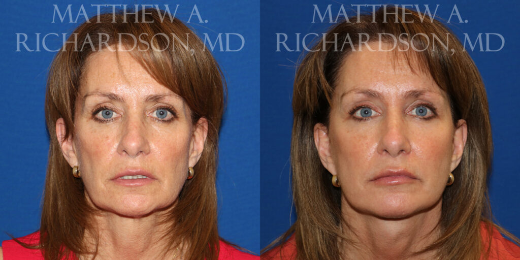 Fat Transfer Before and After photo by Texas Facial Aesthetics in Frisco, TX