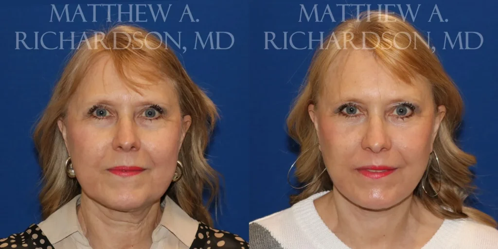 Fat Transfer Before and After photo by Texas Facial Aesthetics in Frisco, TX