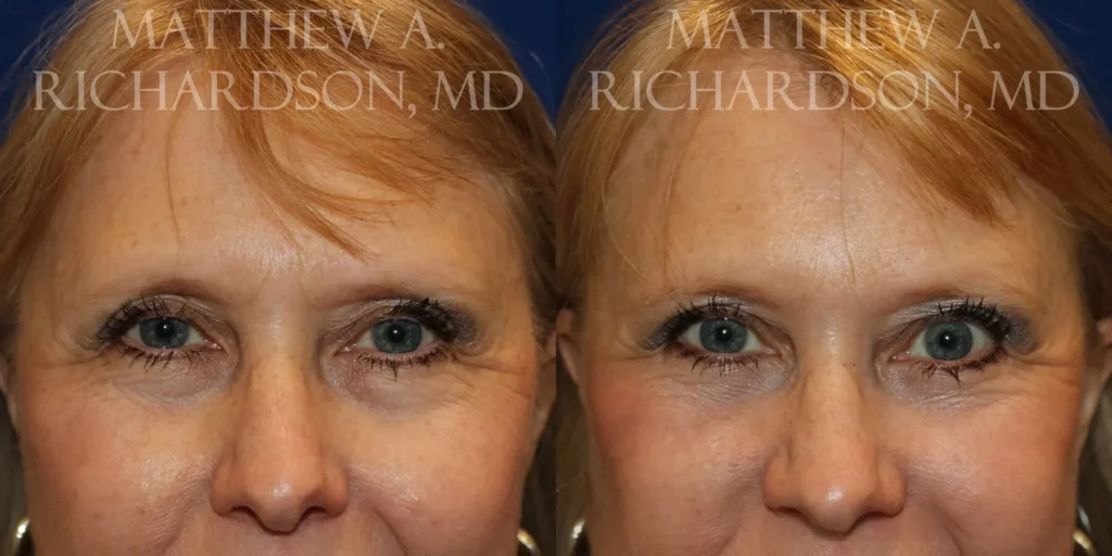 Fat Transfer Before and After photo by Texas Facial Aesthetics in Frisco, TX