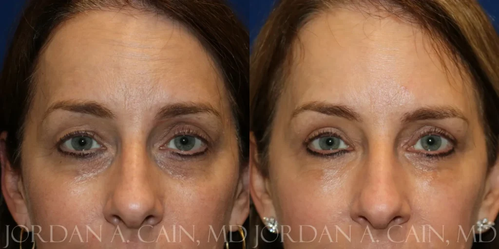 Fat Transfer Before and After photo by Texas Facial Aesthetics in Frisco, TX