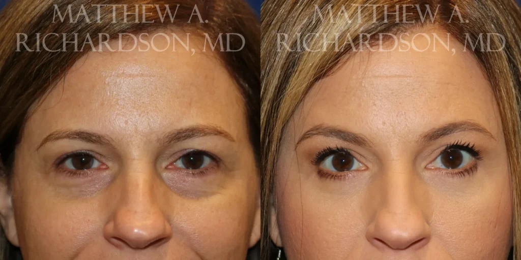 Fat Transfer Before and After photo by Texas Facial Aesthetics in Frisco, TX