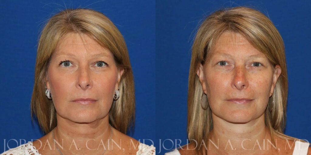 Neck Lift Before and After photo by Texas Facial Aesthetics in Frisco, TX