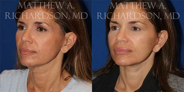 Neck Lift Before and After photo by Texas Facial Aesthetics in Frisco, TX