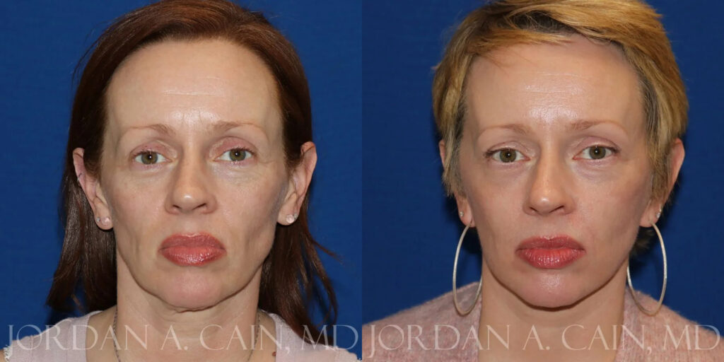 Neck Lift Before and After photo by Texas Facial Aesthetics in Frisco, TX