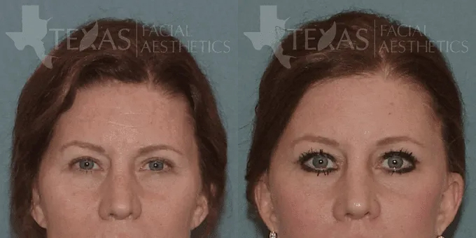 Neck Lift Before and After photo by Texas Facial Aesthetics in Frisco, TX