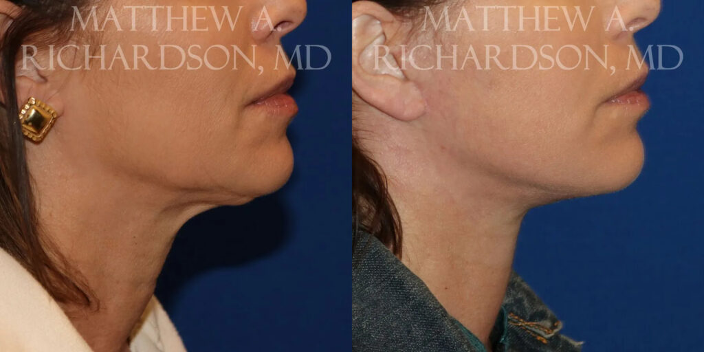 Neck Lift Before and After photo by Texas Facial Aesthetics in Frisco, TX
