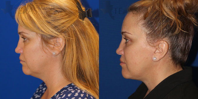 Neck Lift Before and After photo by Texas Facial Aesthetics in Frisco, TX