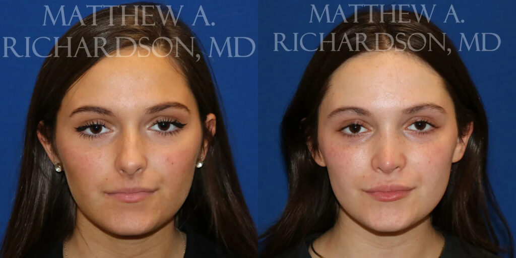 Rhinoplasty (Nose) Before and After photo by Texas Facial Aesthetics in Frisco, TX