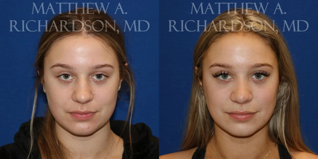 Rhinoplasty (Nose) Before and After photo by Texas Facial Aesthetics in Frisco, TX