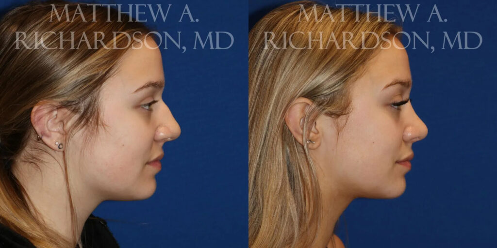 Rhinoplasty (Nose) Before and After photo by Texas Facial Aesthetics in Frisco, TX