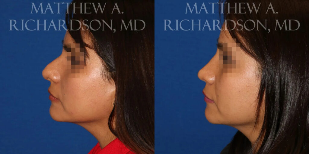 Rhinoplasty (Nose) Before and After photo by Texas Facial Aesthetics in Frisco, TX