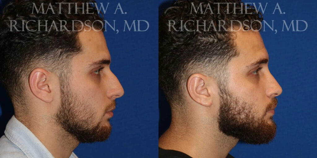 Rhinoplasty (Nose) Before and After photo by Texas Facial Aesthetics in Frisco, TX