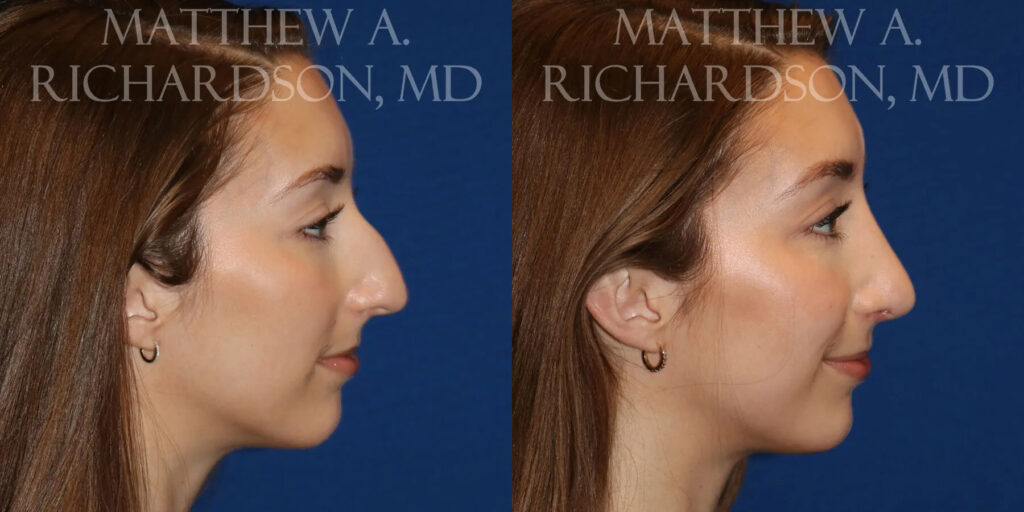 Rhinoplasty (Nose) Before and After photo by Texas Facial Aesthetics in Frisco, TX