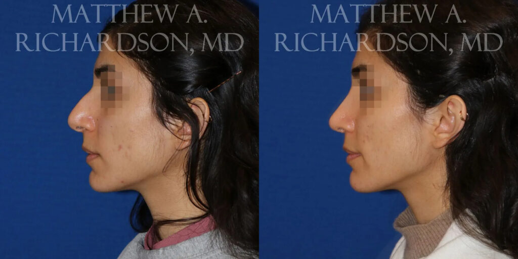 Rhinoplasty (Nose) Before and After photo by Texas Facial Aesthetics in Frisco, TX