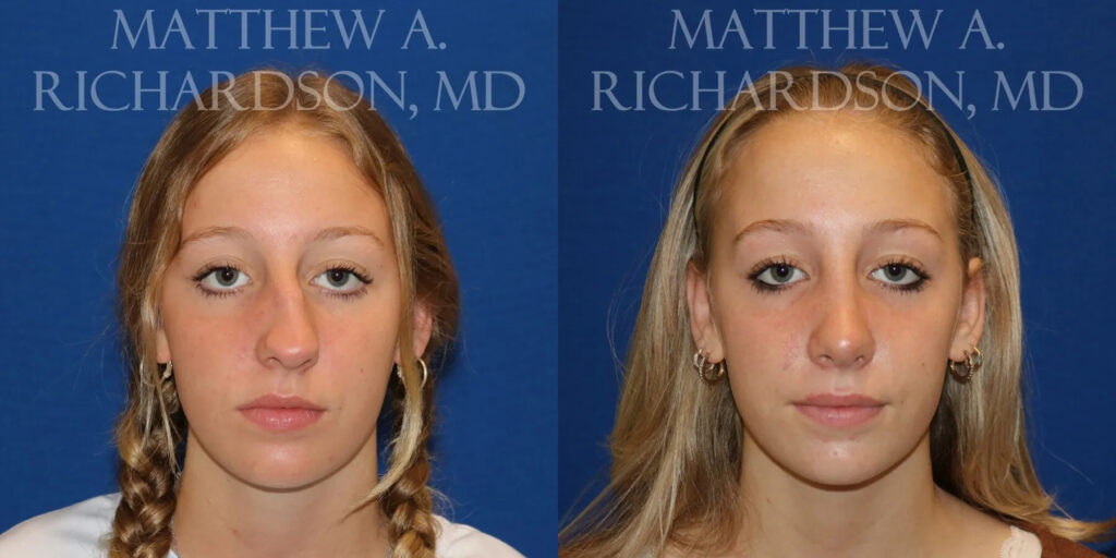 Rhinoplasty (Nose) Before and After photo by Texas Facial Aesthetics in Frisco, TX