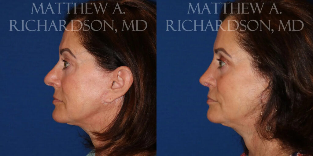 Rhinoplasty (Nose) Before and After photo by Texas Facial Aesthetics in Frisco, TX