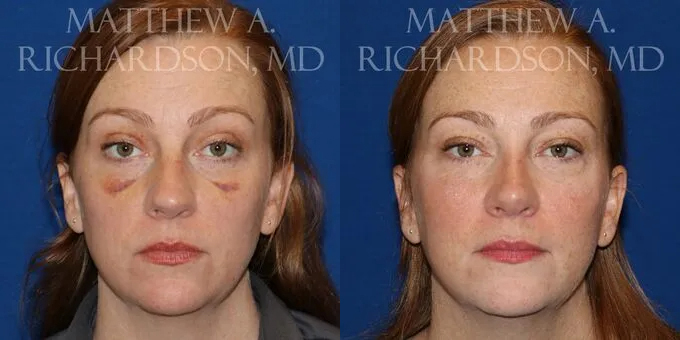 Rhinoplasty (Nose) Before and After photo by Texas Facial Aesthetics in Frisco, TX