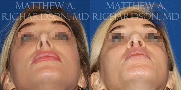 Rhinoplasty (Nose) Before and After photo by Texas Facial Aesthetics in Frisco, TX