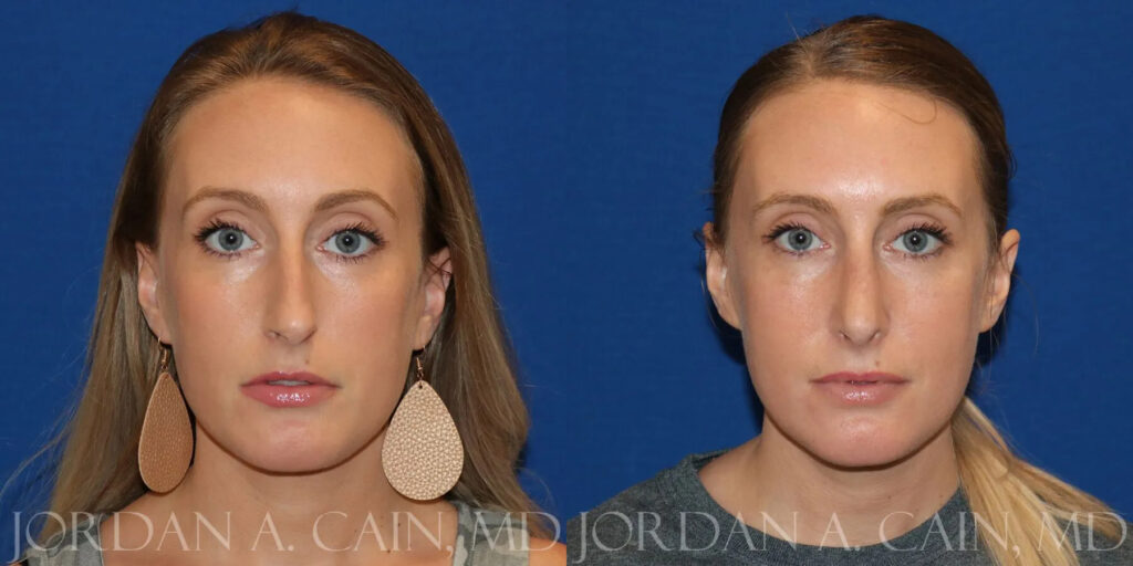 Rhinoplasty (Nose) Before and After photo by Texas Facial Aesthetics in Frisco, TX