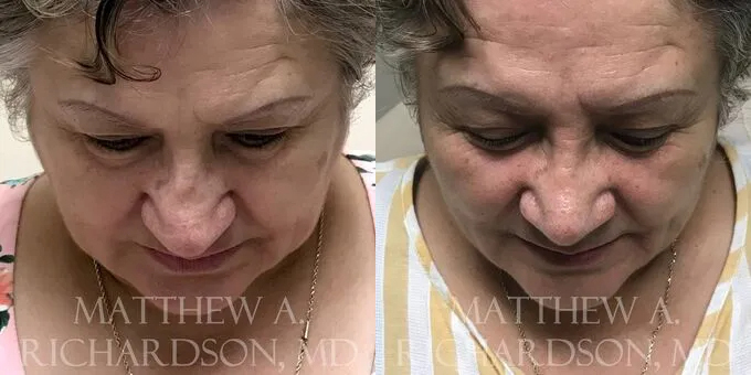 Rhinoplasty (Nose) Before and After photo by Texas Facial Aesthetics in Frisco, TX