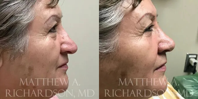 Rhinoplasty (Nose) Before and After photo by Texas Facial Aesthetics in Frisco, TX