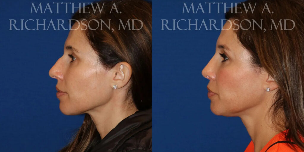 Rhinoplasty (Nose) Before and After photo by Texas Facial Aesthetics in Frisco, TX