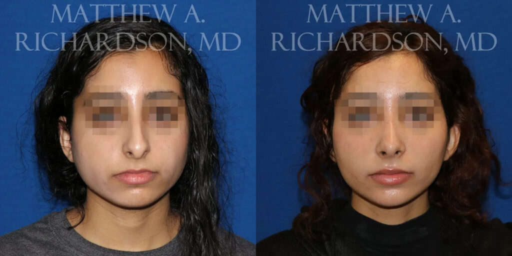 Rhinoplasty (Nose) Before and After photo by Texas Facial Aesthetics in Frisco, TX