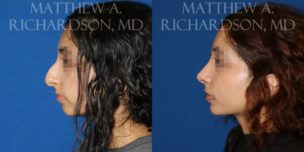 Rhinoplasty (Nose) Before and After photo by Texas Facial Aesthetics in Frisco, TX