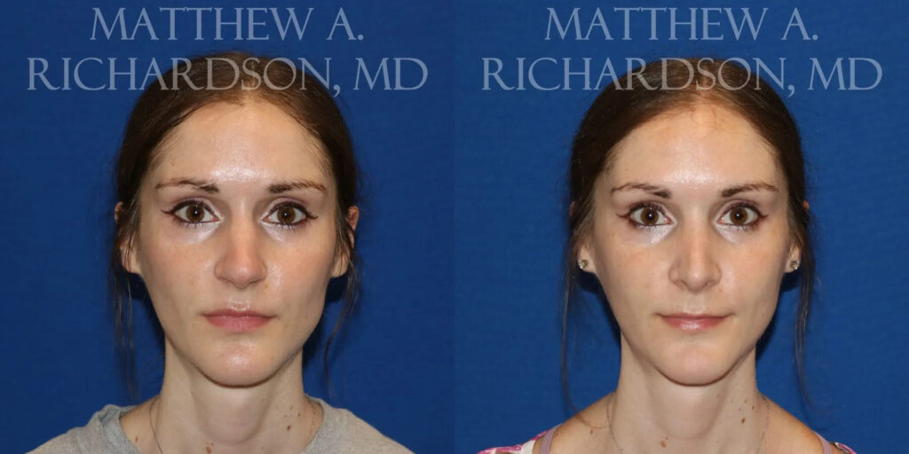 Rhinoplasty (Nose) Before and After photo by Texas Facial Aesthetics in Frisco, TX