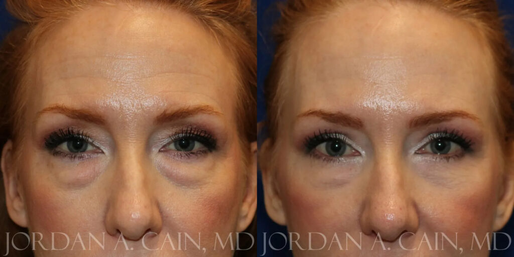 Blepharoplasty (Eyelids) Before and After photo by Texas Facial Aesthetics in Frisco, TX