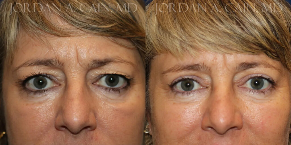 Blepharoplasty (Eyelids) Before and After photo by Texas Facial Aesthetics in Frisco, TX
