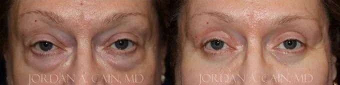 Blepharoplasty (Eyelids) Before and After photo by Texas Facial Aesthetics in Frisco, TX