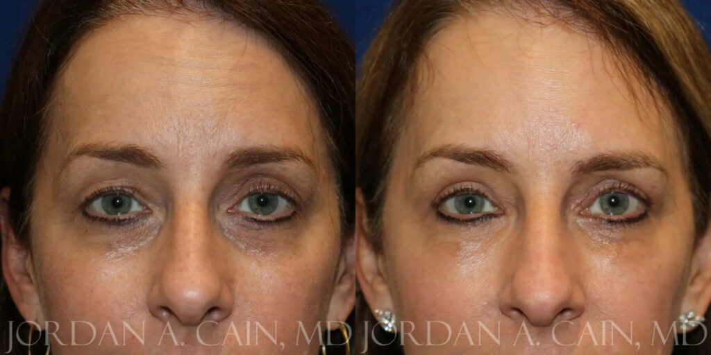 Blepharoplasty (Eyelids) Before and After photo by Texas Facial Aesthetics in Frisco, TX