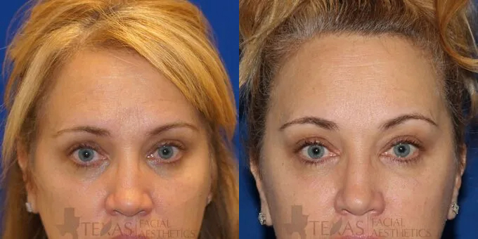 Brow Lift Before and After photo by Texas Facial Aesthetics in Frisco, TX