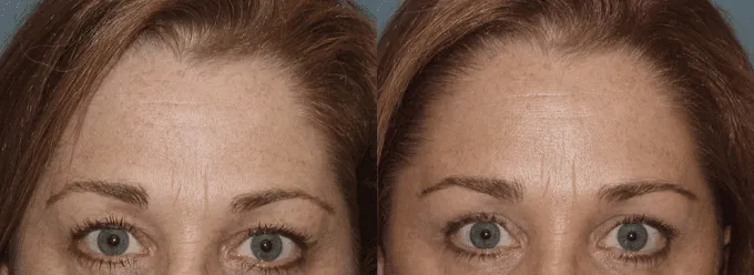 Brow Lift Before and After photo by Texas Facial Aesthetics in Frisco, TX