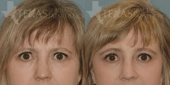 Brow Lift Before and After photo by Texas Facial Aesthetics in Frisco, TX