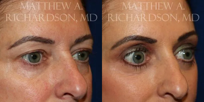 Brow Lift Before and After photo by Texas Facial Aesthetics in Frisco, TX