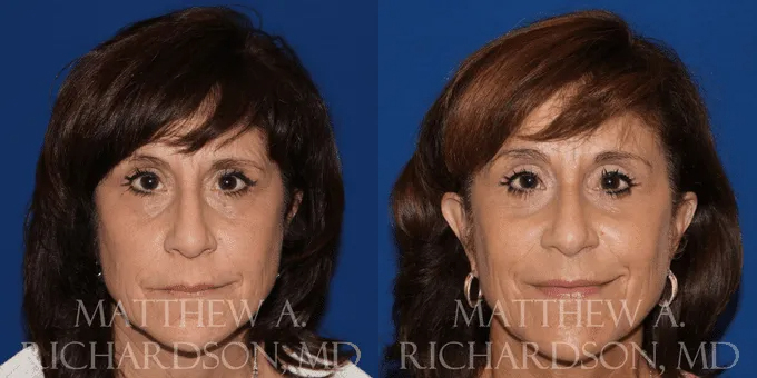 Brow Lift Before and After photo by Texas Facial Aesthetics in Frisco, TX